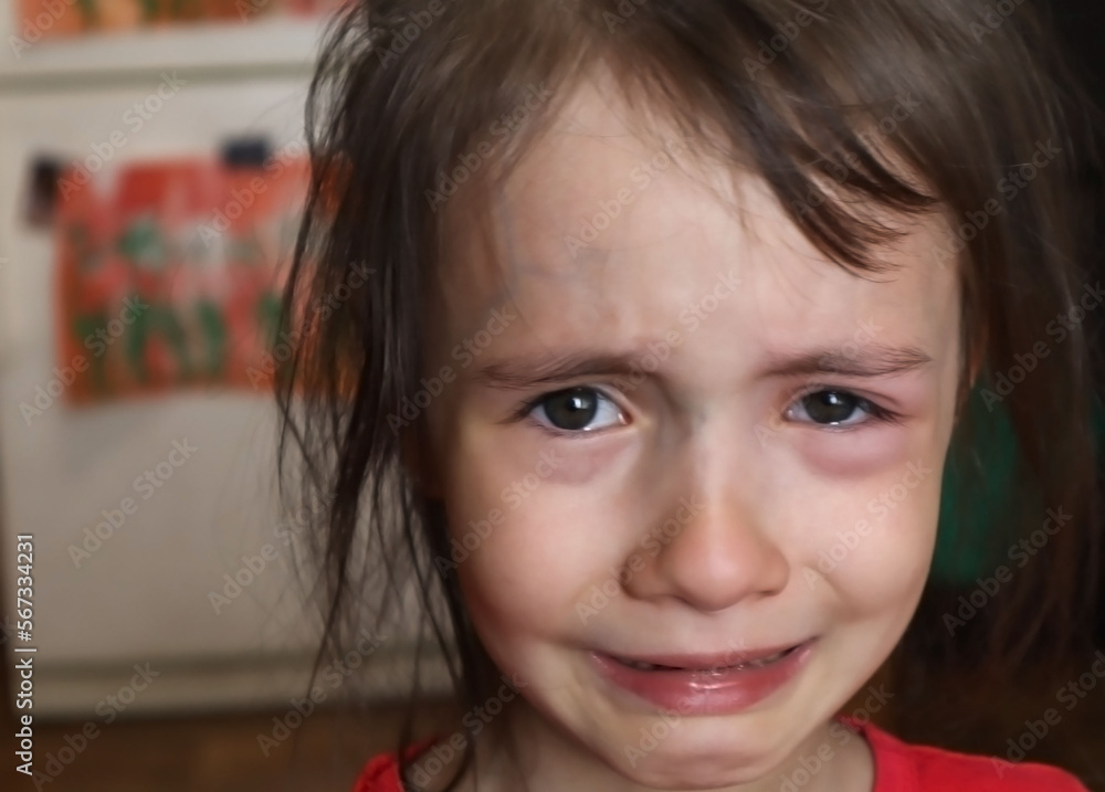 the baby is crying,Child with red swollen eye from insect bite. Quincke