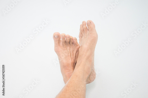 foot dermatitis in elderly people © yongyut