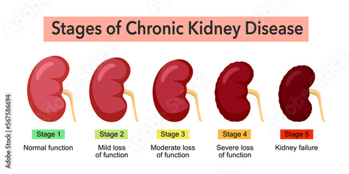 Stages of chronic kidney disease infographic concept vector illustration on white background.