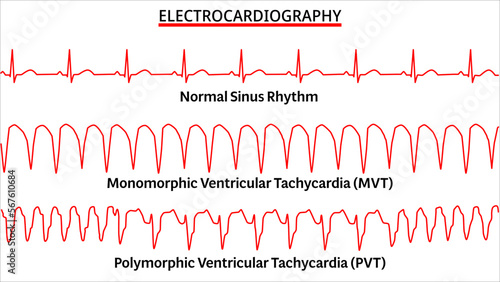 Set of ECG Common Abnormalities - Normal Sinus Rhythm - Monomorphic VT - Polymorphic VT - Vector Medical Illustration