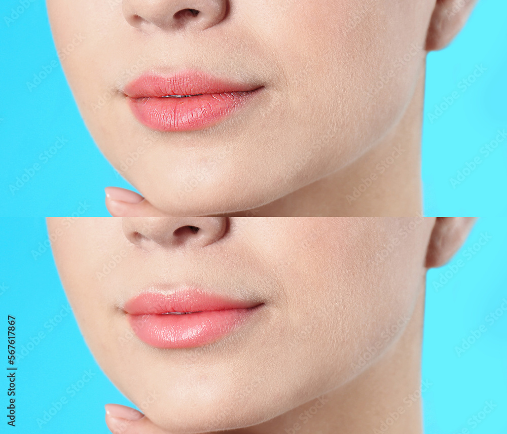 Obraz premium Collage with photos of woman before and after using lip balm on light blue background, closeup