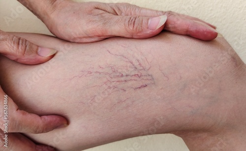 close up the wrinkle and red lines, showing the hand holding the varicose veins and spider on the leg, problem circulation of blood, painful on the knee patient woman, health care and medical concept.