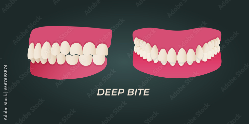 Medical dental diagram illustration. Orthodontist human tooth anatomy. Vector infographics with teeth diagrams. Medical dental diagram illustration. Orthodontist human tooth anatomy. Vector infographics with teeth diagrams.