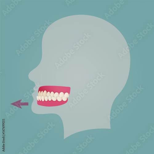 Human teeth malocclusion set with realistic images of mouth jaws with crooked teeth and text captions. Normal and abnormal occlusion. Vector illustration