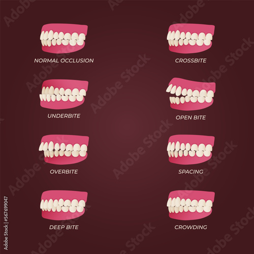 Human teeth malocclusion set with realistic images of mouth jaws with crooked teeth and text captions. Normal and abnormal occlusion. Vector illustration