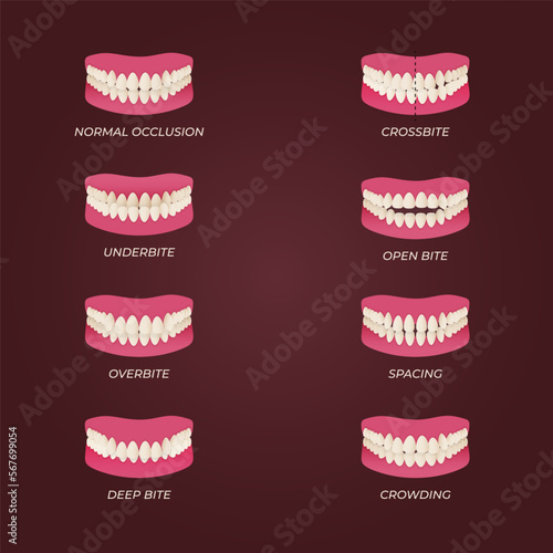 Human teeth malocclusion set with realistic images of mouth jaws with crooked teeth and text captions. Normal and abnormal occlusion. Vector illustration