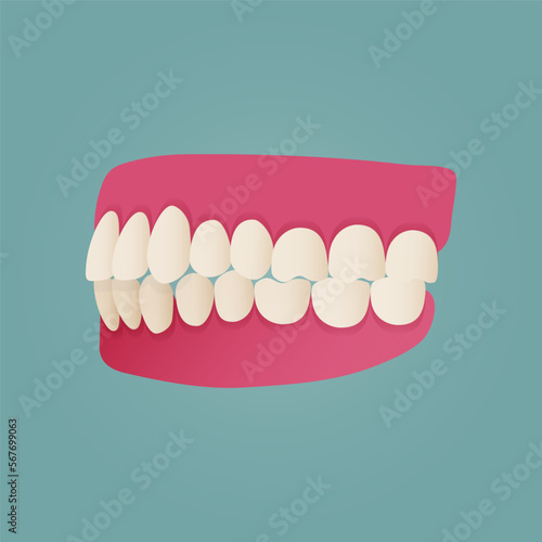 Human teeth malocclusion set with realistic images of mouth jaws with crooked teeth and text captions. Normal and abnormal occlusion. Vector illustration