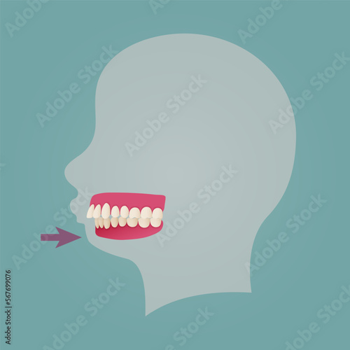 Human teeth malocclusion set with realistic images of mouth jaws with crooked teeth and text captions. Normal and abnormal occlusion. Vector illustration