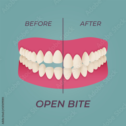 Human teeth malocclusion set with realistic images of mouth jaws with crooked teeth and text captions. Normal and abnormal occlusion. Vector illustration