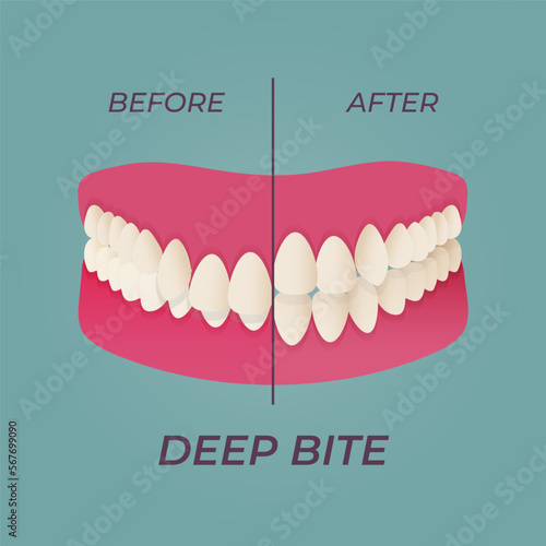 Human teeth malocclusion set with realistic images of mouth jaws with crooked teeth and text captions. Normal and abnormal occlusion. Vector illustration