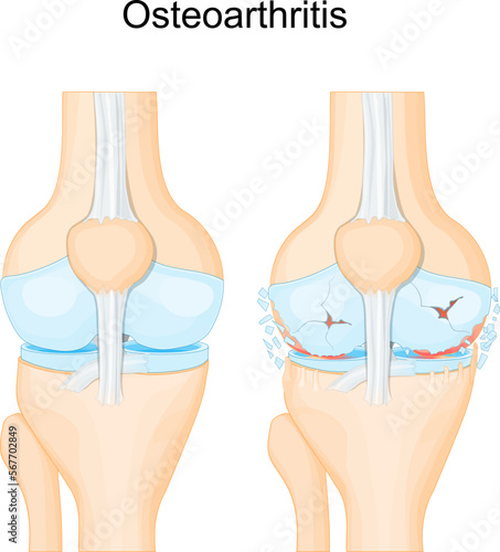 Knee osteoarthritis. degenerative joint disease