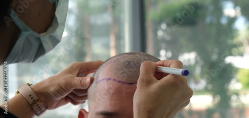 doctor check before hair transplant