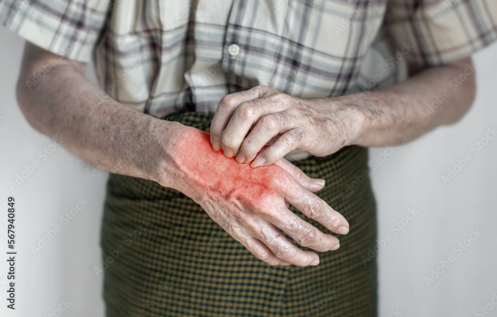 Asian man scratching his hand. Concept of itchy skin diseases such as scabies, fungal infection, eczema, psoriasis, rash, allergy, etc. Asian man scratching his hand. Concept of itchy skin diseases such as scabies, fungal infection, eczema, psoriasis, rash, allergy, etc.
