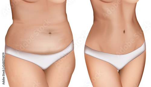 Vector illustration of fat and slim female body. Cellulite body problem. Before and after weight loss.