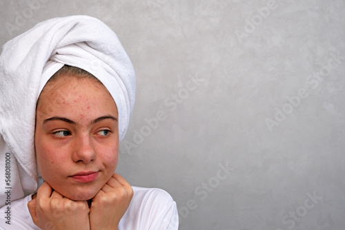 teenage girl with acne on her face.