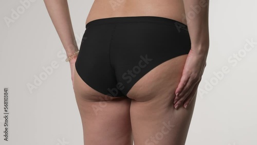 Woman compressing the skin of the legs, checking for cellulite, stretch marks.	

