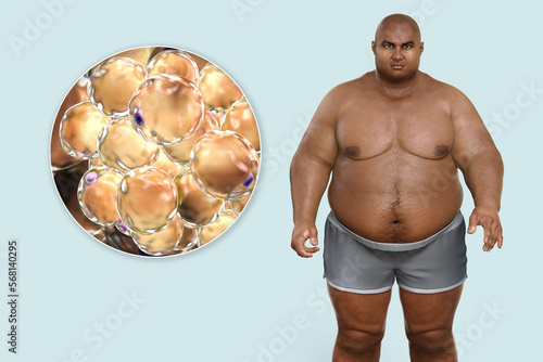 Quadro em tela Obese man and close-up view of fat cells, 3D illustration
