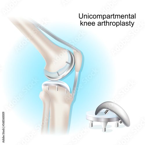 Unicompartmental knee arthroplasty. surgical procedure