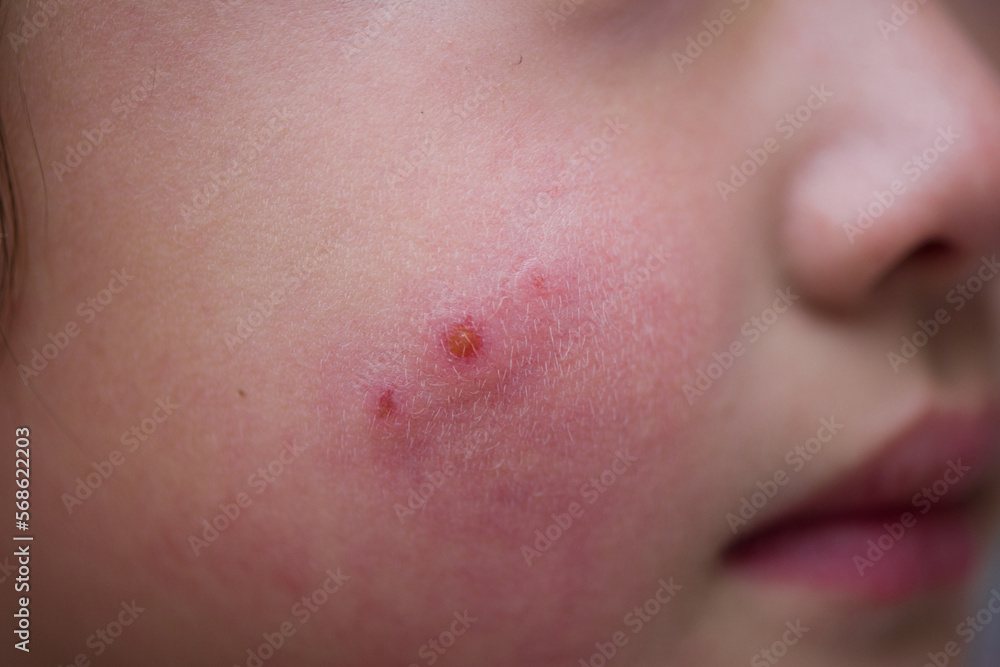 close up of child face with chilblain close up of child face with chilblain