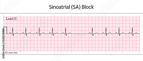 Sinoatrial (SA) Block ECG - 8 Second ECG Paper - Vector Medical Illustration