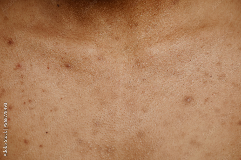 Macro shot of tan skin with acne scar spots and texture