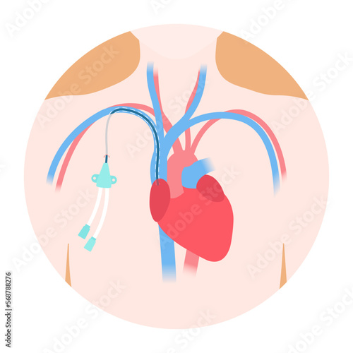 Tunneled central venous catheter placed in the subclavian vein. Patient with CVC long term access device for chemotherapy infusions and blood sampling. Central line tube close up. Vector illustration.