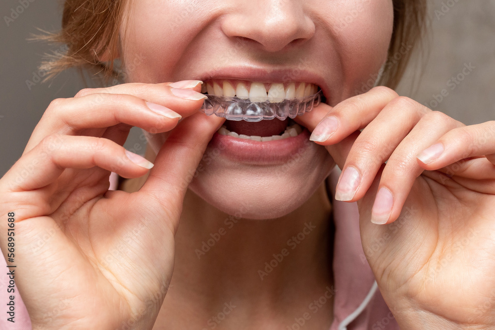 Dental aligner in hands of woman with great smile Dental aligner in hands of woman with great smile