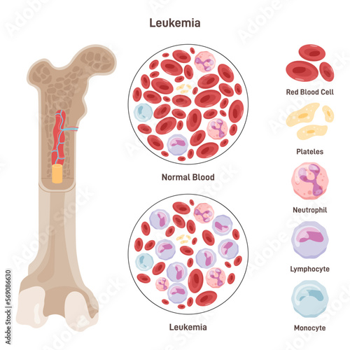 Normal blood and blood affected by leukemia disease. Dangerous photo