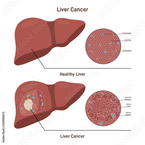 Liver cancer. Comparison between healthy organ and liver with carcinoma