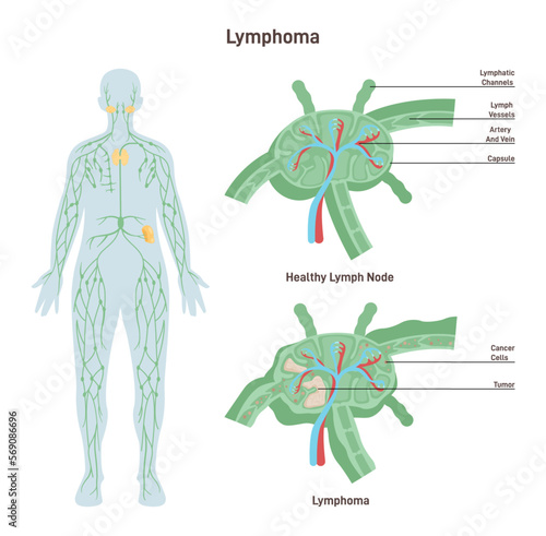 Lymphoma. Healthy lymph node structure and lymph node affected