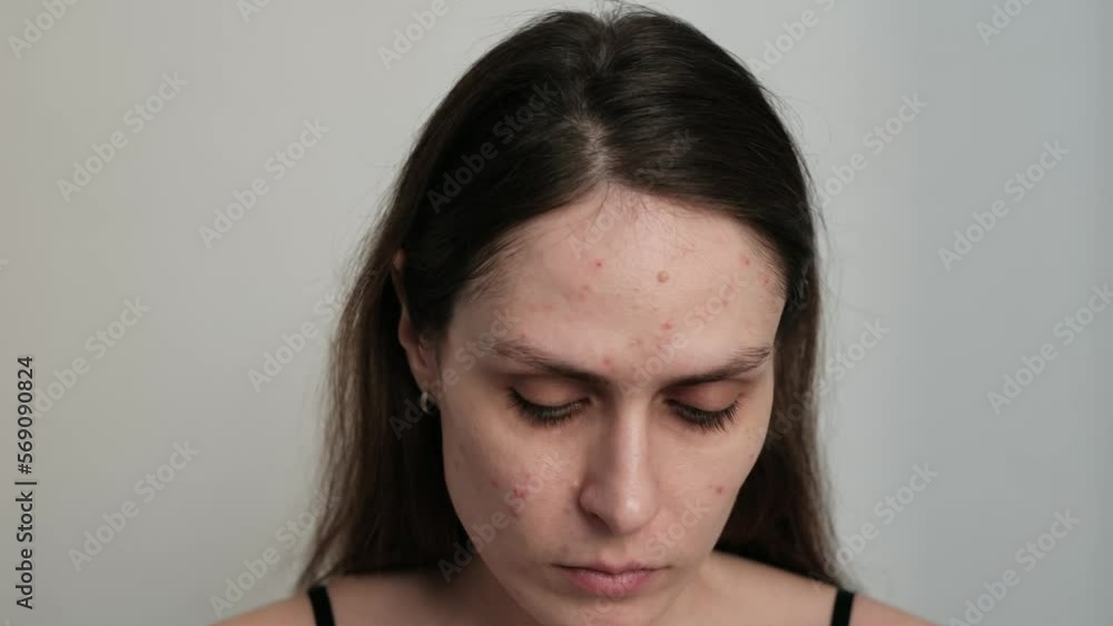 Woman applies makeup, cream serum cure for acne on face. Close-up acne on woman's face with rash skin ,scar and spot that allergic to cosmetics. Problem skin care and health concept. Wrinkles, melasma Woman applies makeup, cream serum cure for acne on face. Close-up acne on woman's face with rash skin ,scar and spot that allergic to cosmetics. Problem skin care and health concept. Wrinkles, melasma