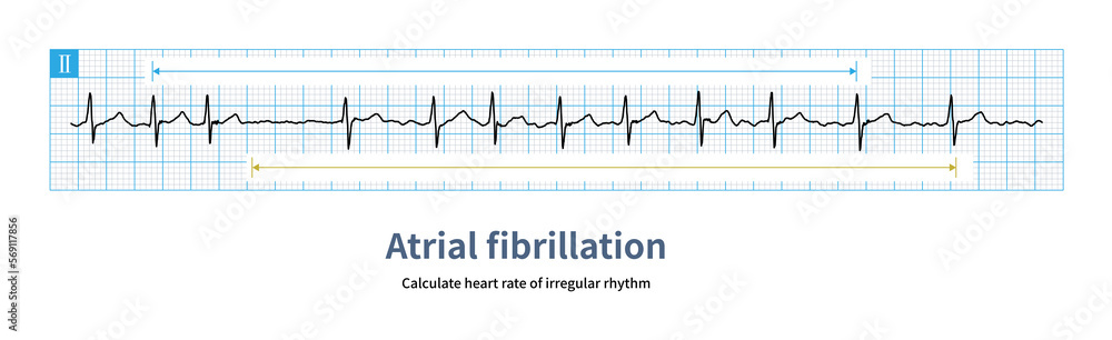 Atrial fibrillation is a kind of atrial tachyarrhythmia, and the ventricular rate is absolutely irregular.You can calculate the mean cardiac cycle of 10 heartbeats.