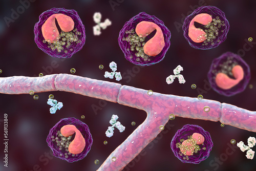 Splendore-Hoeppli phenomenon, 3D illustration. Eosinophilic reaction around the invading fungal hyphae in human tissues photo