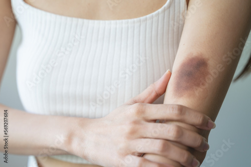 woman get injured and have bruised on her arm.