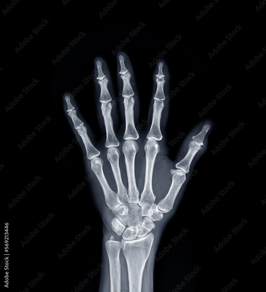 Film x-ray Left Hand AP view show human's hands isolated on black background . Film x-ray Left Hand AP view show human's hands isolated on black background .