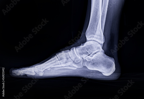 Foot x-ray image Lateral view  isolated on black background. photo