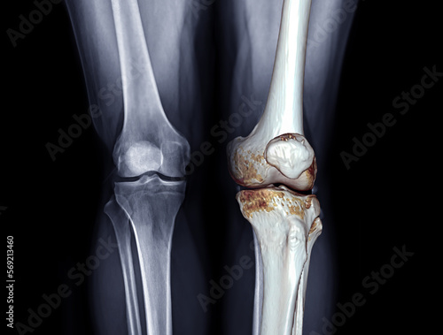 X-ray image of both knee AP view for diagnostic Osteoarthritis or knee fracrure.