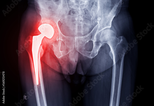 x-ray Both hip ap view showing Right hip replacement or hip prosthesis made from titanium.