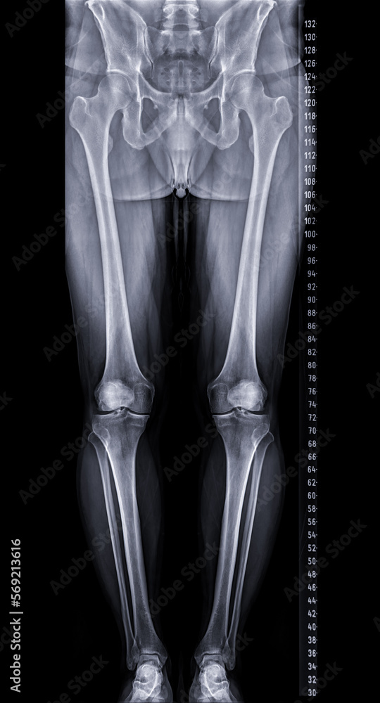 Scanogram is a Fulllength standing AP radiograph of both lower