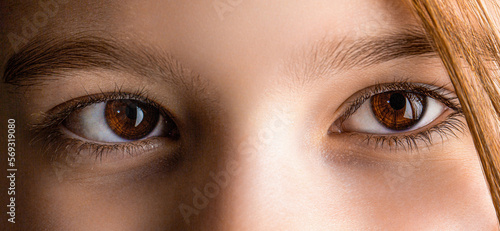 Strabismus. Close-up part child's face, eyes girl. Little patient strabismus, treatment ophthalmic diseases. Strabismus in children causes, treatment concept. Female eyes with strabismus. Hypertropia photo