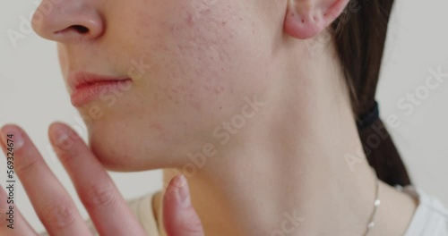 Cropped view of the teen woman touching acne pores on the skin of her face