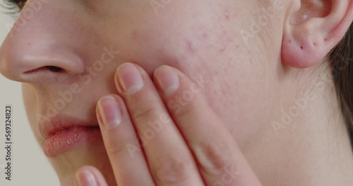 Close up view of the young woman touching acne skin photo