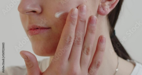 Cropped view of the teen girl with problem skin applying treatment cream