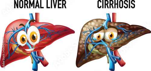 Normal liver and cirrhosis