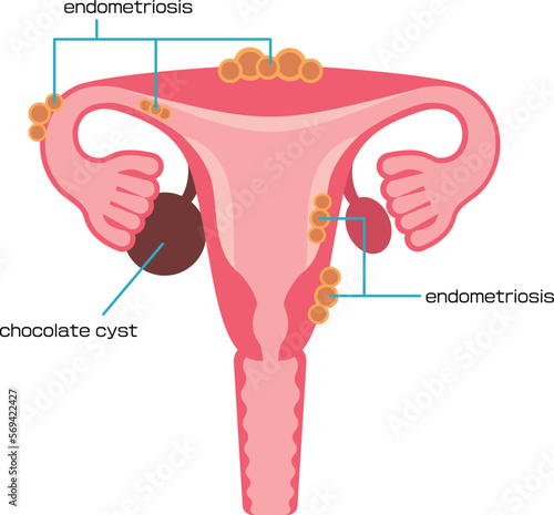 子宮内膜症の種類／Illustrated types of endometriosis