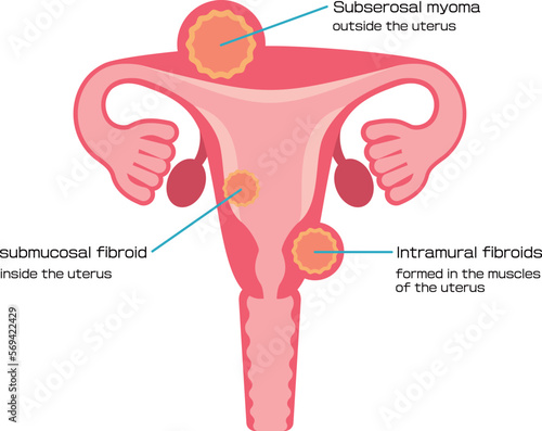子宮筋腫の種類／Illustrated types of uterine fibroids