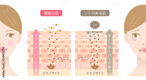 肌のシミとターンオーバー　肌細胞　女性　ビフォアアフター