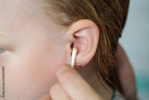 Φωτογραφία Cleaning a child's ear with a cotton swab from contamination of the ear drum and ear canal