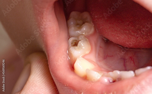 Wallpaper Mural Deep caries in children on milk teeth. Treatment of caries, toothache. Baby teeth, macro Torontodigital.ca