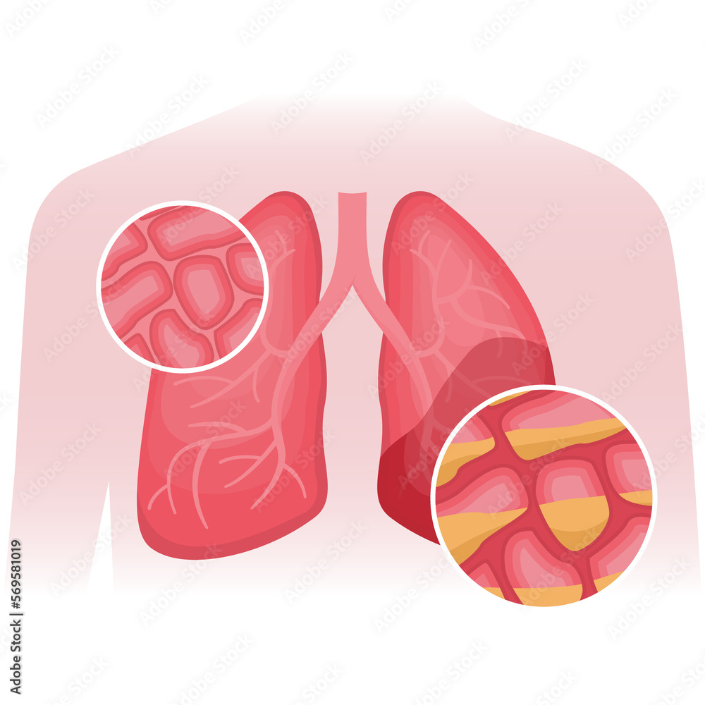 Pneumonia causes an accumulation of fluid in the alveoli. Flat vector illustration of human lungs. Organs damaged by viral disease, coronavirus Pneumonia causes an accumulation of fluid in the alveoli. Flat vector illustration of human lungs. Organs damaged by viral disease, coronavirus
